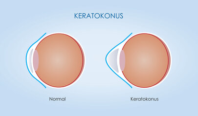 Keratokonus